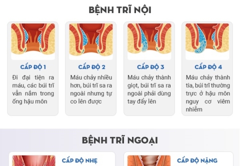 Có bao nhiêu loại trĩ và chúng khác nhau thế nào?